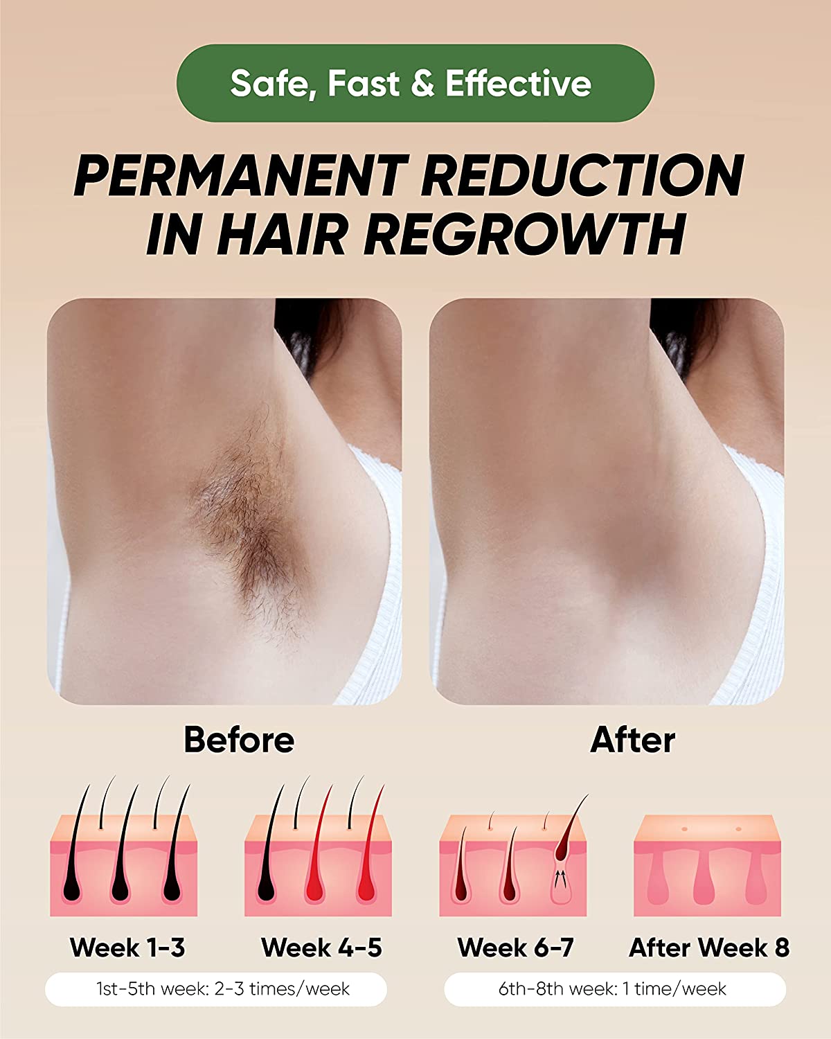 IPL Laser Hair Removal Device